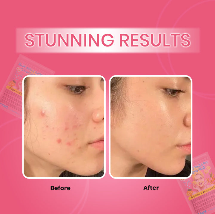 Turmeric Kojic Acid Exfoliating Cleansing Pads